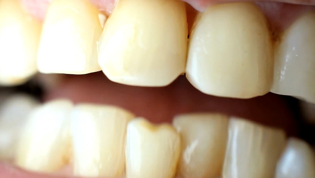 Close up view of person's yellow teeth